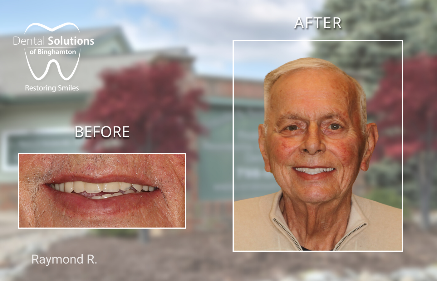 Hybridge Dental Implants